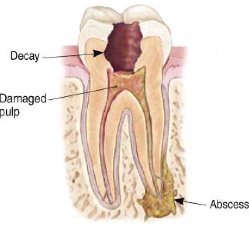 Root Canal (posterior tooth)-500x500